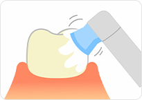 歯面の研磨